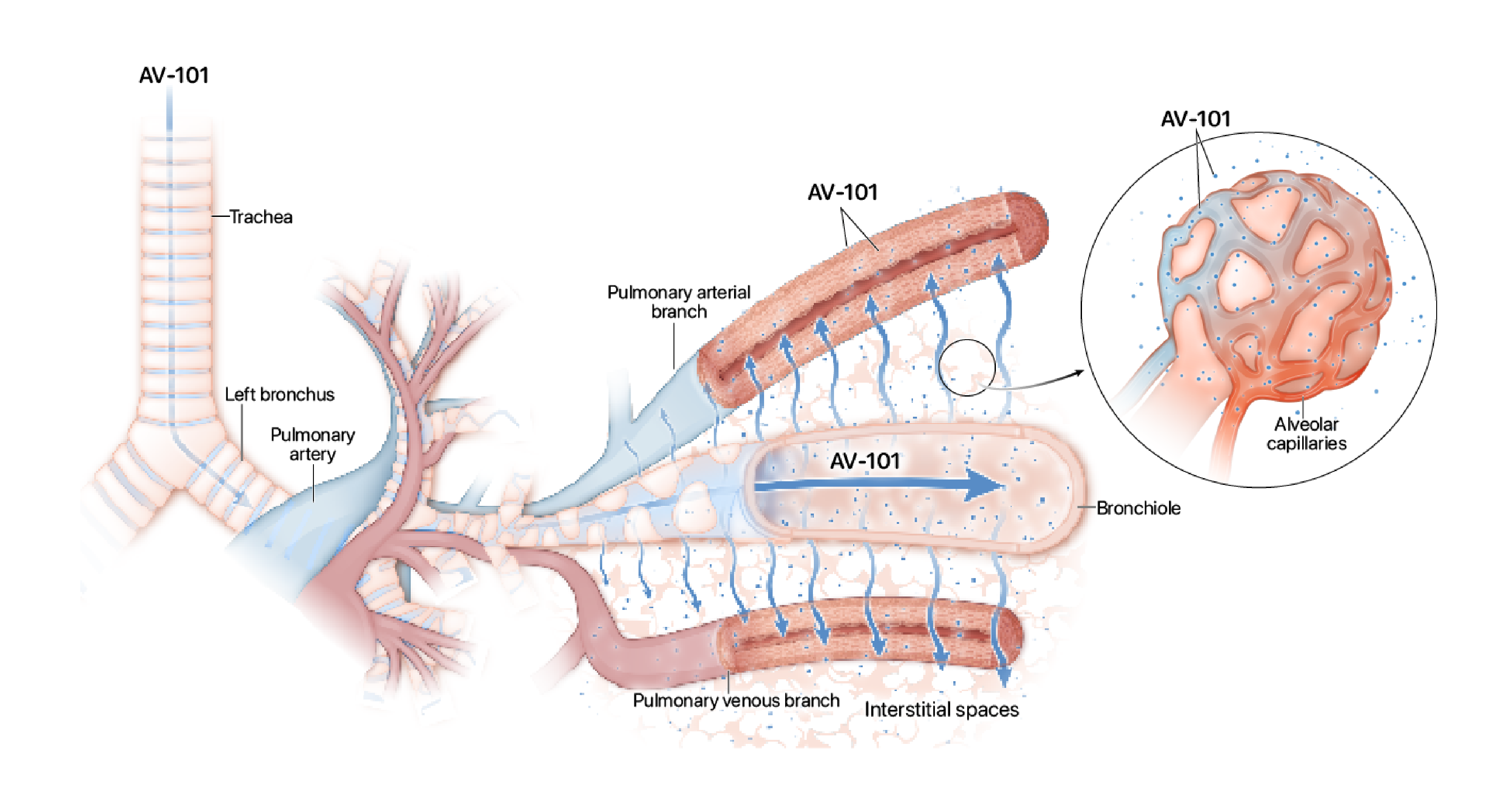 AV-101 delivering imatinib throughout the airways, permeating the lung and reaching the surrounding tissue and blood vessels